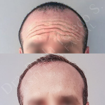 Alt Paciente hombre que se aplica botox en frente