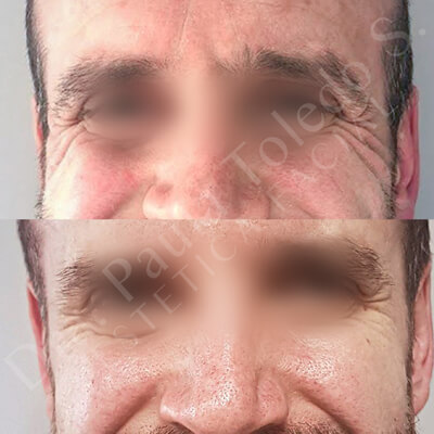 Alt Paciente con Botox