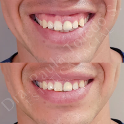 Alt embellecimiento de sonrisa