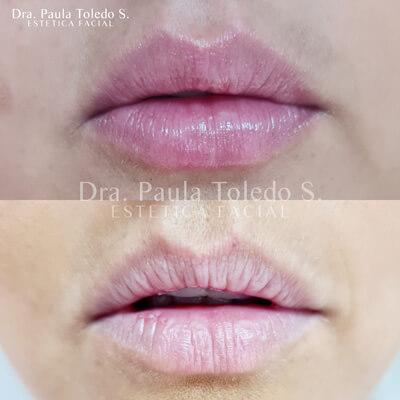 Alt relleno de labios