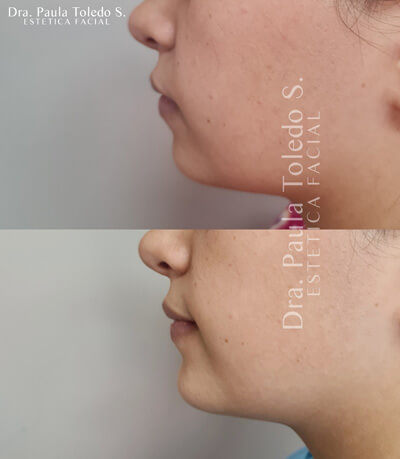 Alt tratamiento de implante de menton en paciente