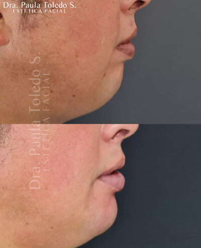 Alt tratamiento de implante de menton