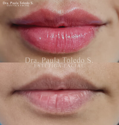Alt Relleno Labios