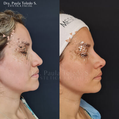 alt Rinomodelación con acido hialuronico