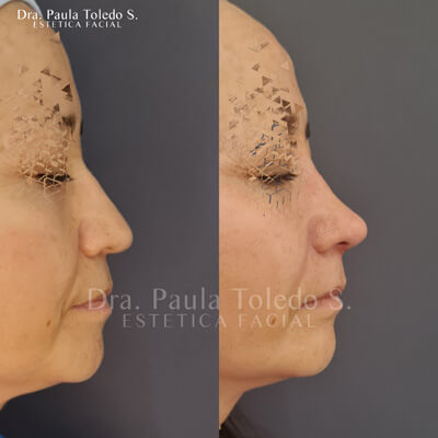 Alt tratamiento de Rinomodelacion e Hilos tensores en paciente mujer