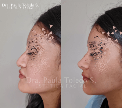 Alt Rinomodelación en paciente