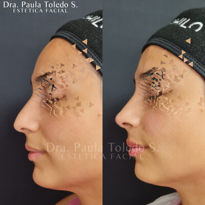 alt rinomodelación con acido hialuronico