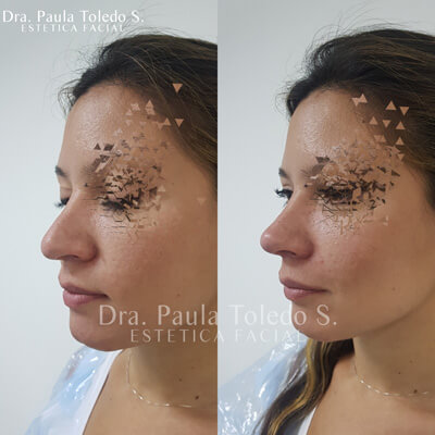 Alt rinomodelación con acido hialuronico