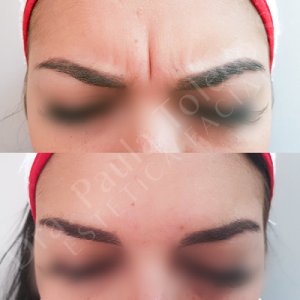 Alt imagen de Botox de entrecejo
