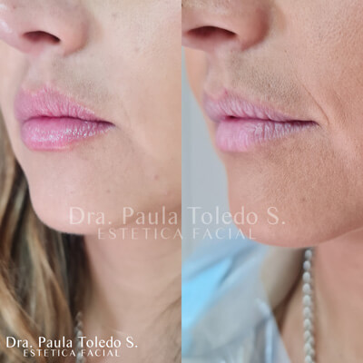 Alt labios con relleno volumen