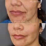 Alt Relleno acido hialuronico para Surco nasogeneano