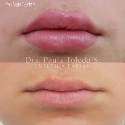 Alt paciente con relleno de labios